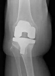 X-ray of a precisely aligned total knee replacement