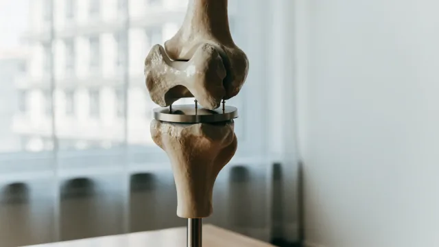 A loosened knee component shown on a high-quality teaching model with a subtle interface gap, realistic clinical photography and no dramatic cracking